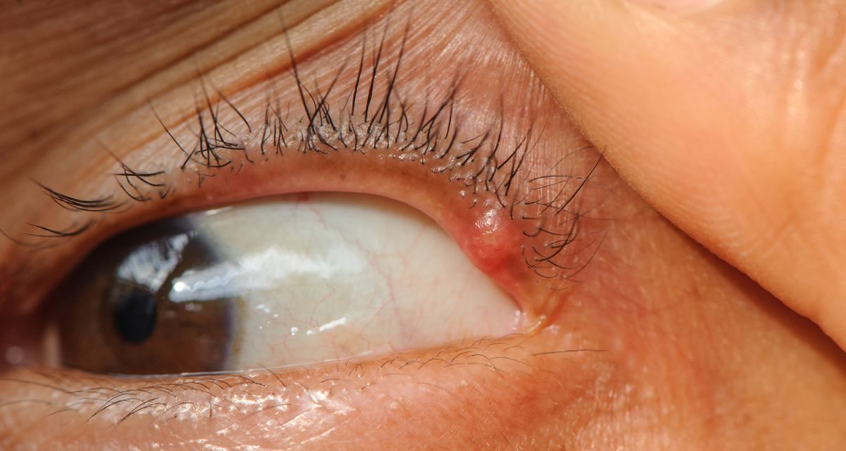 Penyebab Mata Kering Yang Sering Tidak Di Sadari