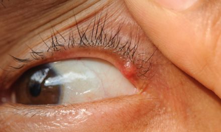 Penyebab Mata Kering Yang Sering Tidak Di Sadari