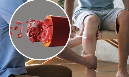 Perubahan Gaya Hidup Untuk Mencegah Dan Mengurangi Varises